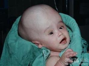 脑积水可以吃酥瓜吗视频