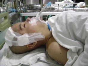 脑积水可以吃酥瓜吗视频